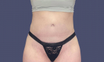 Abdominoplasty (Tummy Tuck) 5 After